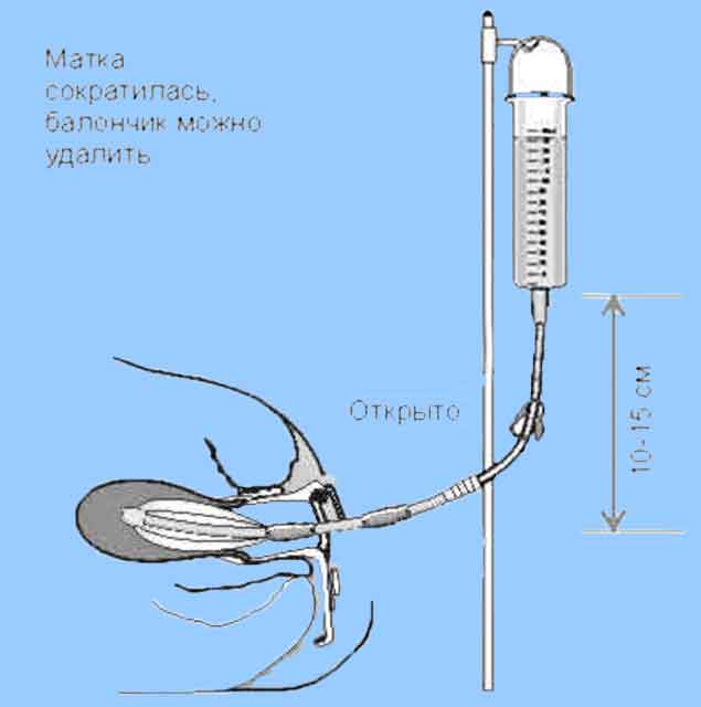 Катетер для матки. Баллон Жуковского катетер маточный. Катетер маточный двухбаллонный Жуковского. Управляемая баллонная маточная тампонада. Баллонная маточная тампонада Жуковского.
